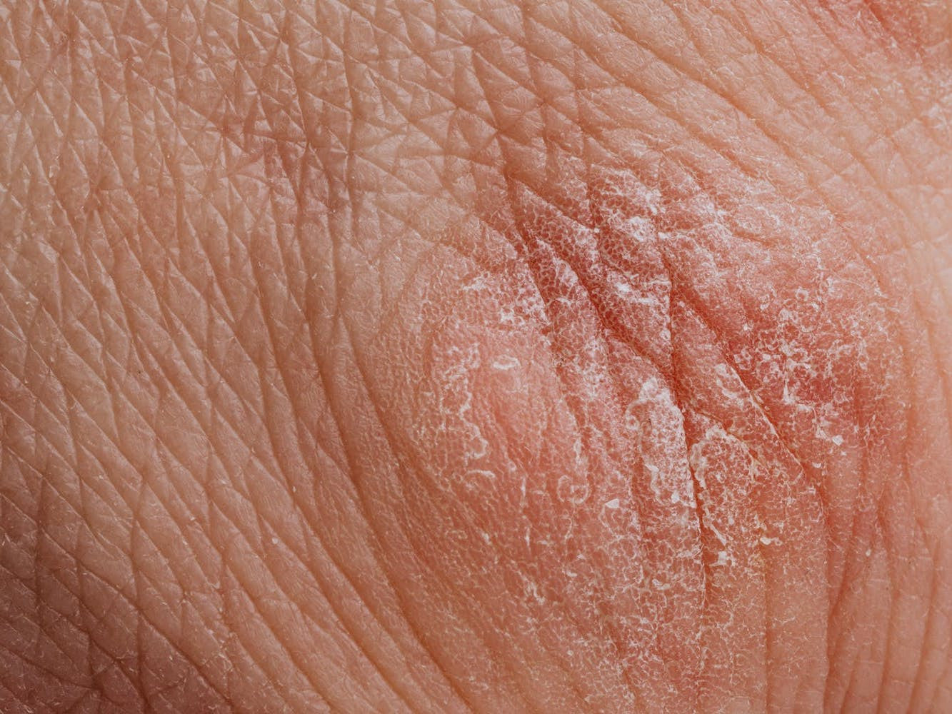 Does everyone with eczema and psoriasis need to avoid dairy?